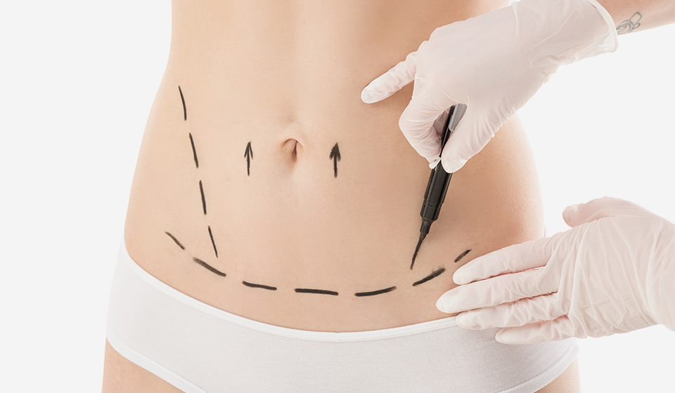 Plan Perfectly: Abdominoplasty Timeline for Brides Before Their Wedding