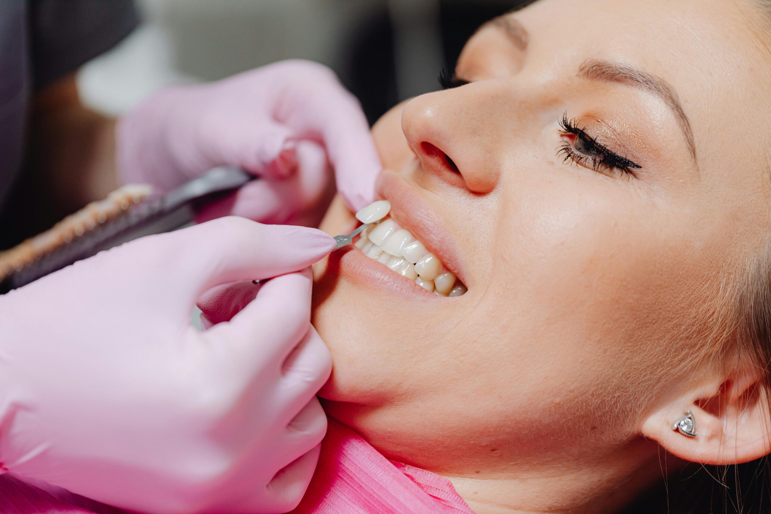 What to Expect When Having Porcelain Veneers Fitted